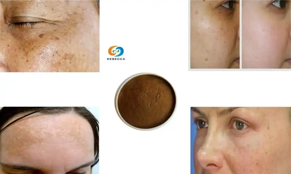 Je, propolis inaweza kuondoa matangazo ya giza?